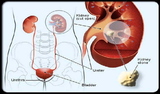Location Of Kidney Stone